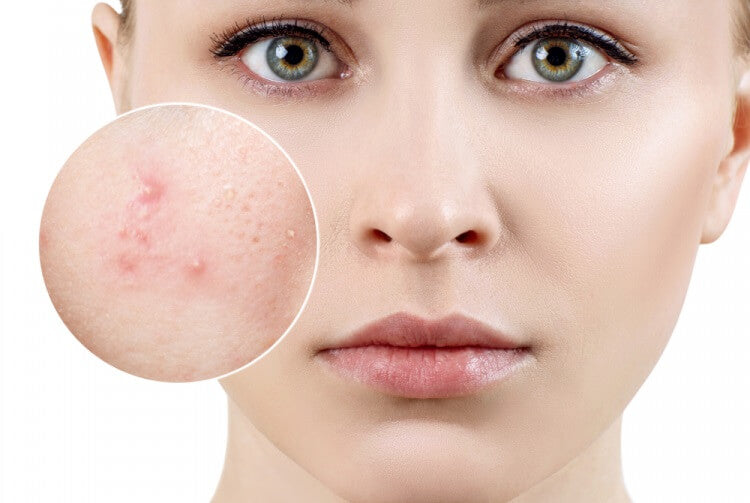 Complete Guide for the Derma Roller System – DermaRollerSystem.com